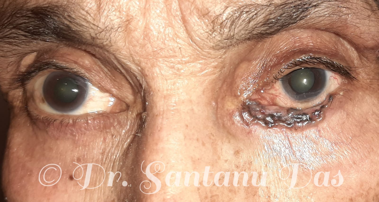 Left lower lid malignant lesion, basal cell carcinoma